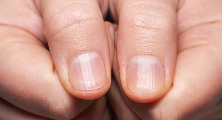 Your Fingernails Have Ridges and White Spots &ndash; It&rsquo;s Not a Calcium Deficiency
