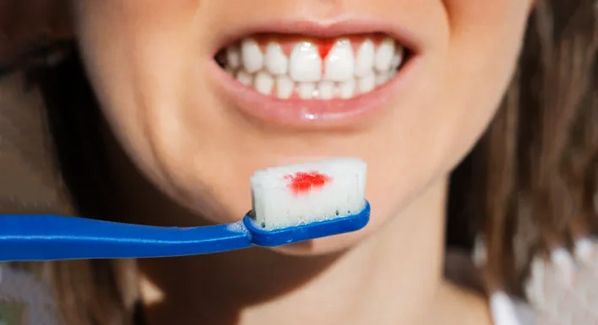 Your Gums Bleed When You Brush &ndash; It&rsquo;s Not the Brush